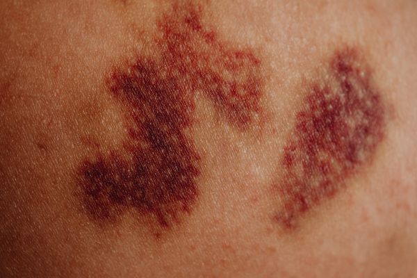 Comprendre la 'zona' : causes, symptômes et traitements