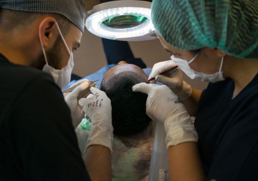 Greffe de cheveux pour calvitie complète : ce qu'il faut savoir