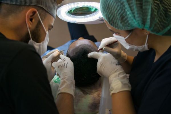 Greffe de cheveux pour calvitie complète : ce qu'il faut savoir