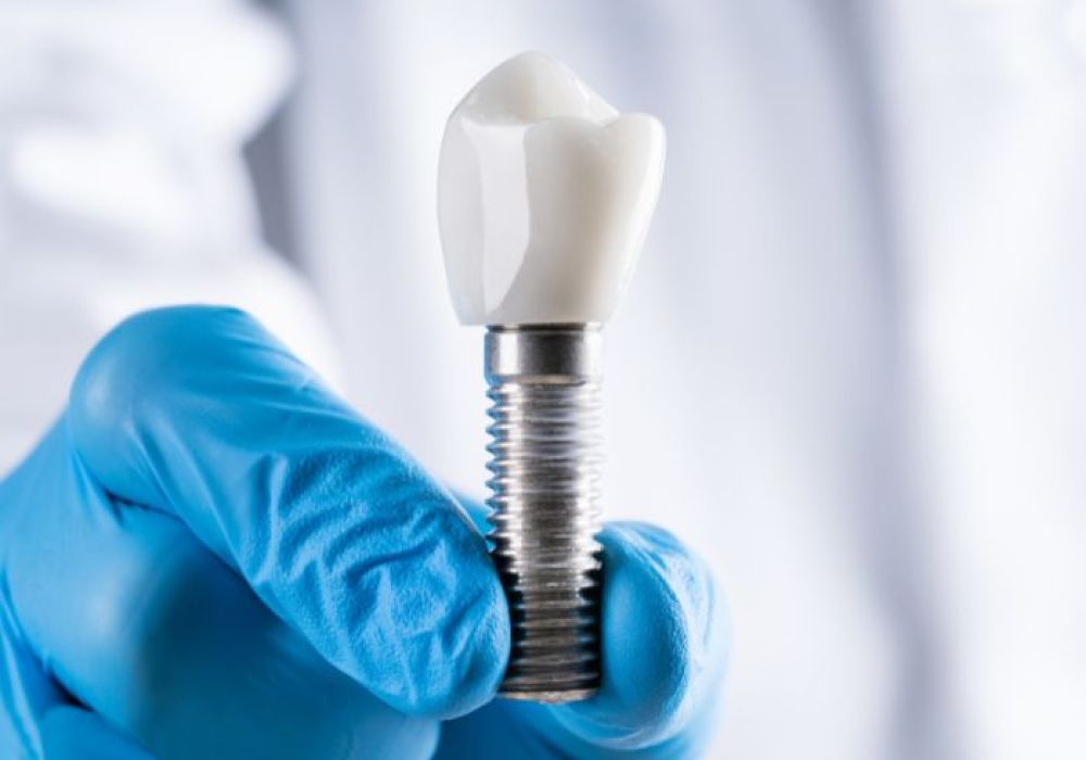 Quelle est la durée de vie d'un implant dentaire ?
