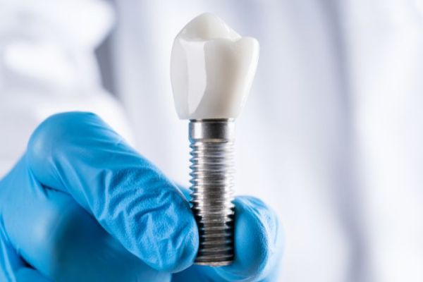 Quelle est la durée de vie d'un implant dentaire ?