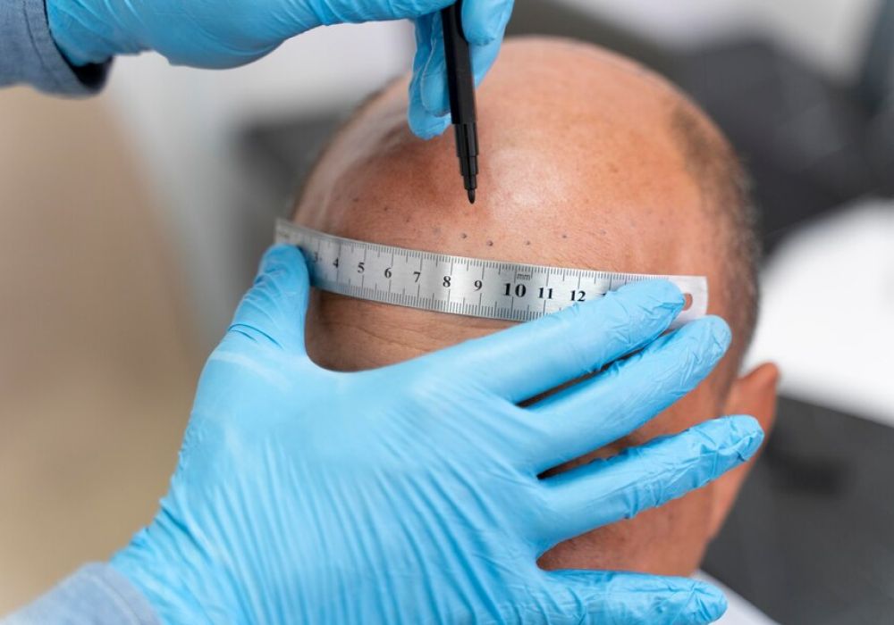 Quelles sont les différentes techniques de greffe de cheveux et avantages associés ?