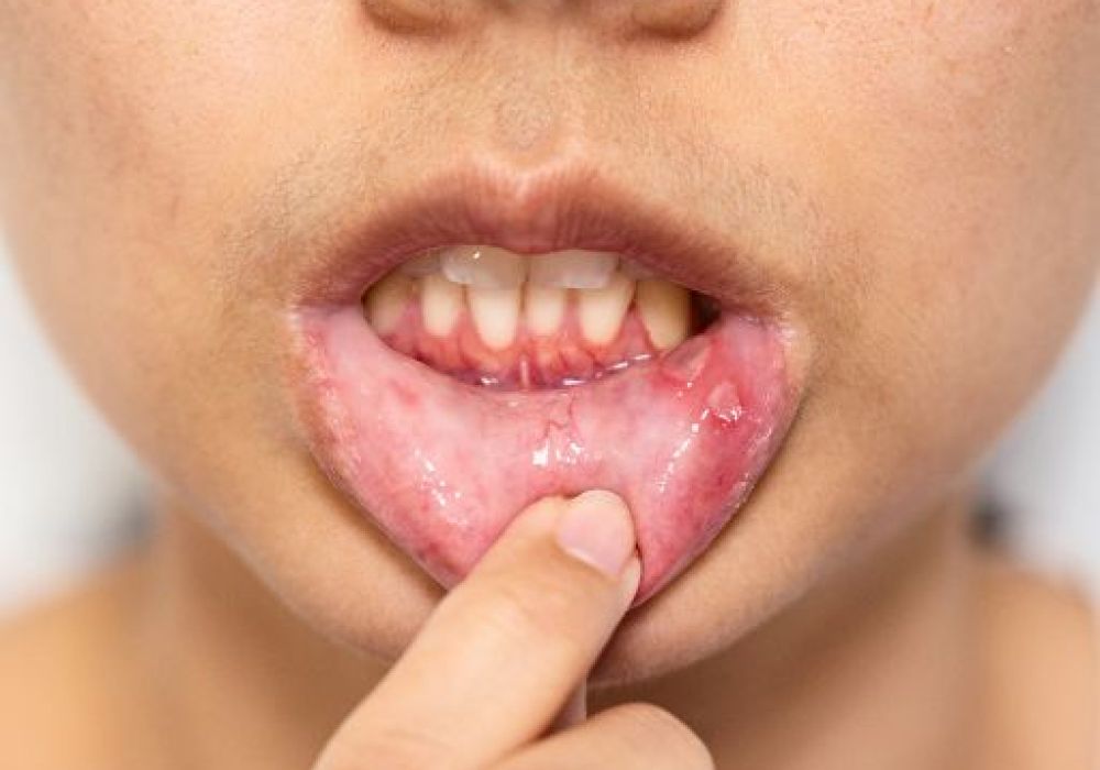 Soulager les aphtes : conseils pour apaiser les irritations buccales