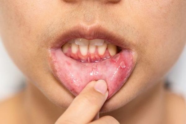 Soulager les aphtes : conseils pour apaiser les irritations buccales