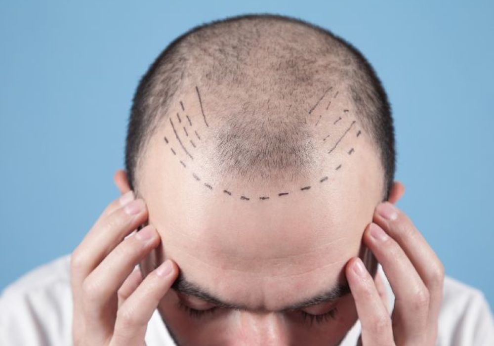 Tout savoir sur la greffe de cheveux en Turquie