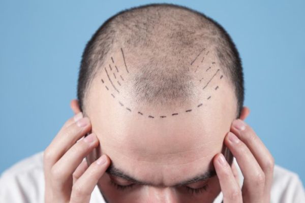 Tout savoir sur la greffe de cheveux en Turquie